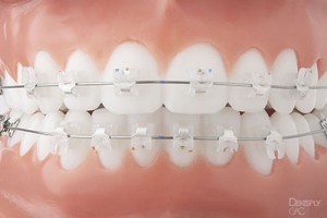 Close-up of teeth with ceramic braces and wire showing orthodontic treatment progress.
