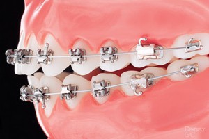 Clear braces with metal brackets and wires attached to upper and lower teeth against pink background.