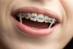 Close-up of smile showing metal braces on upper teeth with elastic bands.