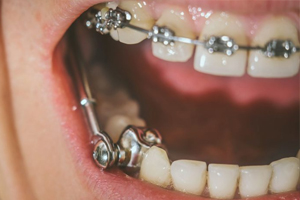 Close-up of teeth with metal braces and decorative dental jewelry in mouth.