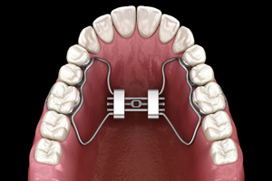 Palatal expander device installed in upper dental arch showing teeth and roof of mouth anatomy.