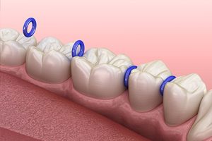 Dental model displaying three teeth with blue orthodontic brackets and wires on pink gum base.