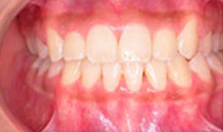 Close-up view of aligned upper and lower teeth showing orthodontic treatment results with healthy pink gums.