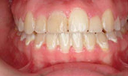 Frontal view of aligned upper and lower teeth showing proper orthodontic treatment results.