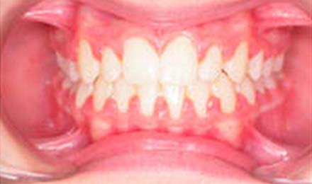 Close-up dental view showing straight teeth alignment and pink gum tissue in orthodontic context.