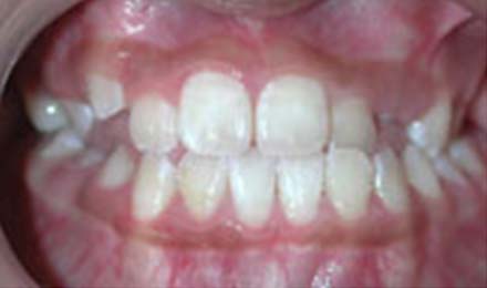 Close-up of aligned teeth showing orthodontic treatment results with proper bite alignment.