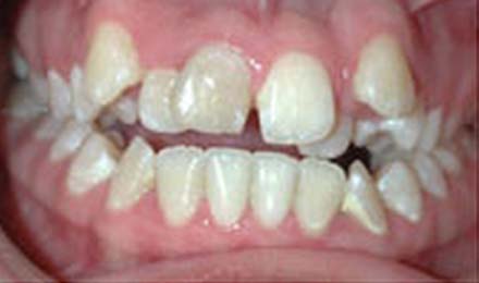 Close-up view of upper and lower teeth showing bite alignment and dental positioning.