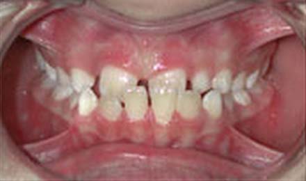 Close-up dental view showing upper and lower teeth with spacing issues before orthodontic treatment.