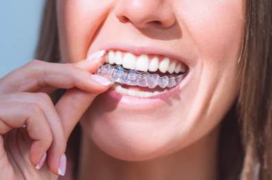 Woman inserting clear aligner into mouth, demonstrating modern orthodontic treatment application.